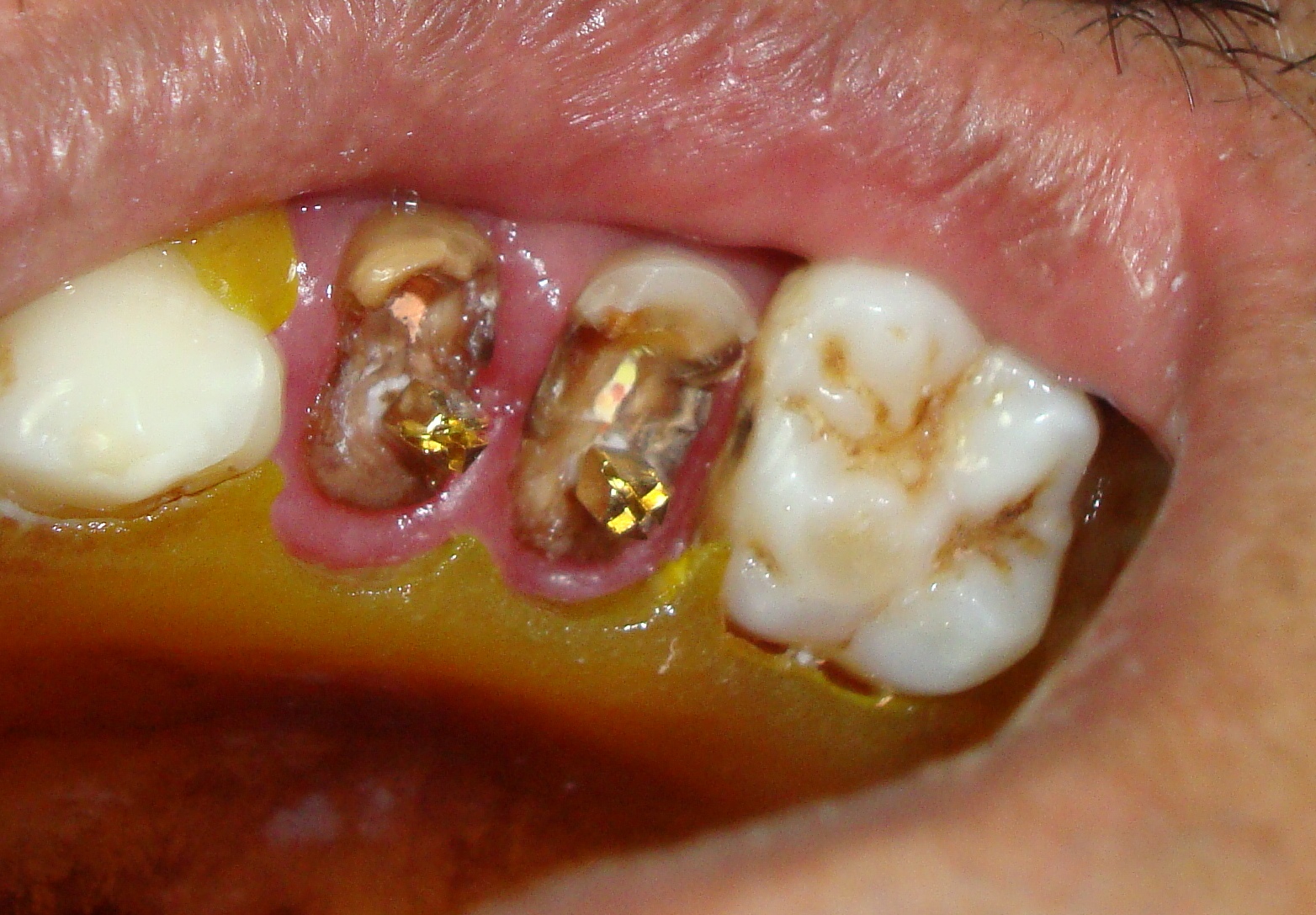 Dental Posts Core Build Up