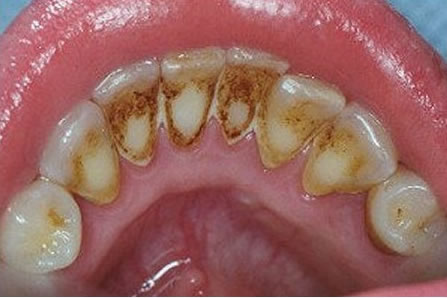 Dental Scaling