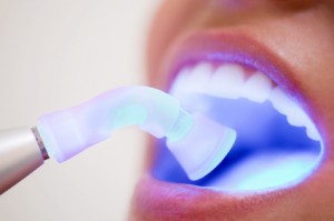 Laser-Teeth-Whitening