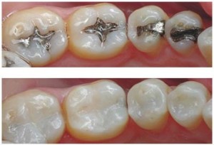 Cosmetic Filling