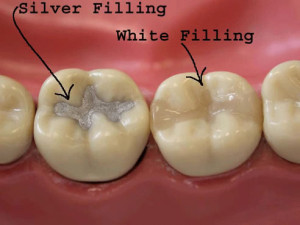 fillings