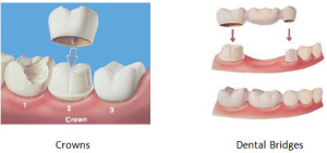 Crowns and Bridges