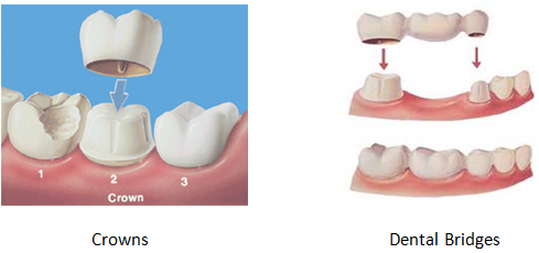 tooth crown bridge