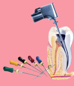 Root Canal Treatment