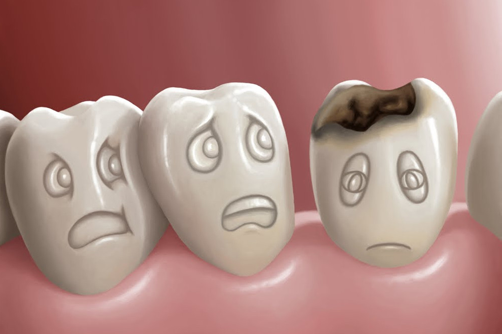 Tooth Decay